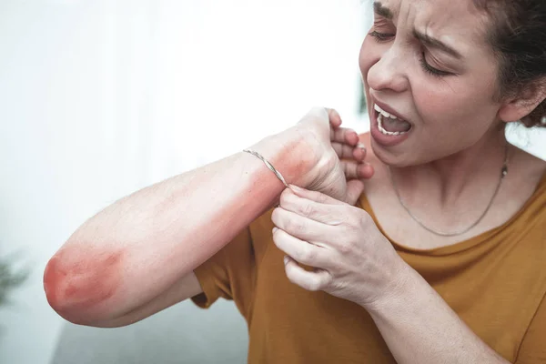 Vrouw gevoel verschrikkelijk vermelding van huiduitslag en roodheid op haar arm — Stockfoto