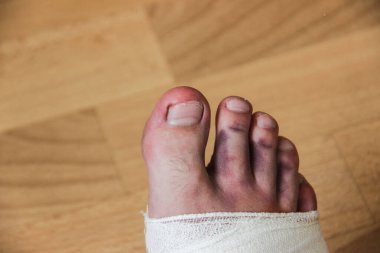 Erkek parmakları sert bir darbeden sonra zedelenir. Katliamdan sonra yalanlar alçıda geri sarıldı..