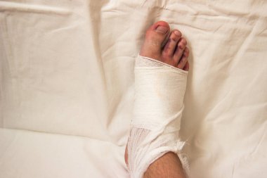 Geri sarma bacağı hastanede yatağın üzerinde duruyor. Güçlü bir darbeden sonra mavi parmaklar bir adamın bacağında.