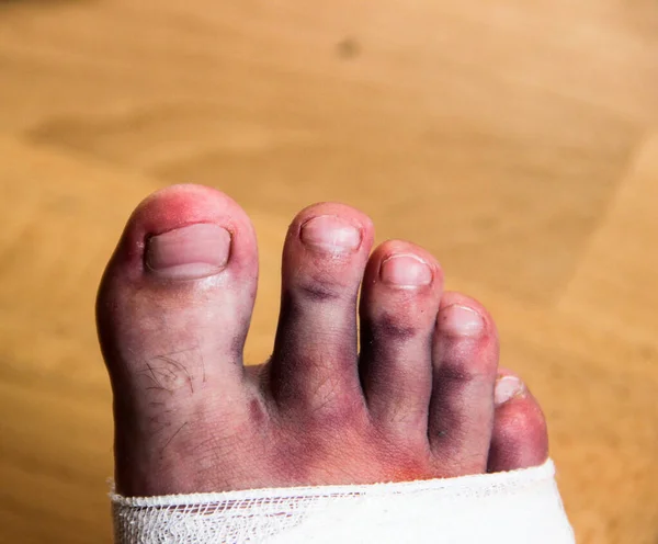 Ένα Αντρικό Πόδι Μετά Από Τραυματισμό Μώλωπες Και Επίδεσμο Τραυματισμένο — Φωτογραφία Αρχείου