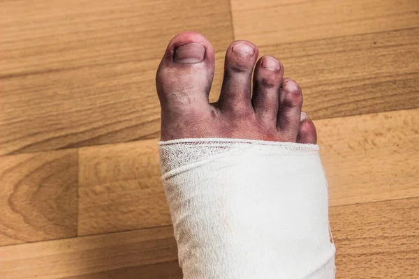 환자는 다리에 들었습니다 붕대에 다리는 바닥에 충격으로 발가락이 바닥에 — 스톡 사진