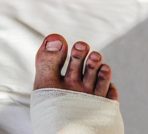 Επανήλθε Πόδι Μετά Από Ένα Δυνατό Χτύπημα Στο Πόδι Μπλε — Φωτογραφία Αρχείου