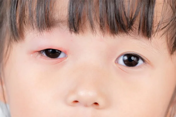 Închideți Inflamația Roșie Ochilor Roz Blefarită Din Gumă Medicinală Pentru — Fotografie, imagine de stoc