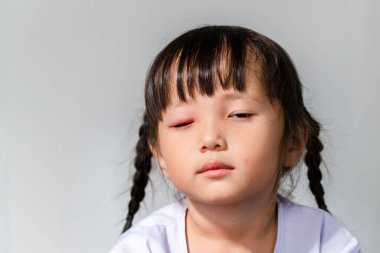 Asian girl with red pink eye inflammation blepharitis from allergy clipart