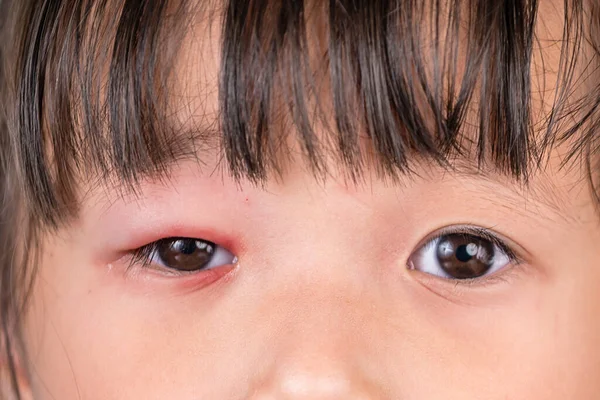 Asiática chica con rojo rosa ojo inflamación blefaritis de la alergia —  Fotos de Stock