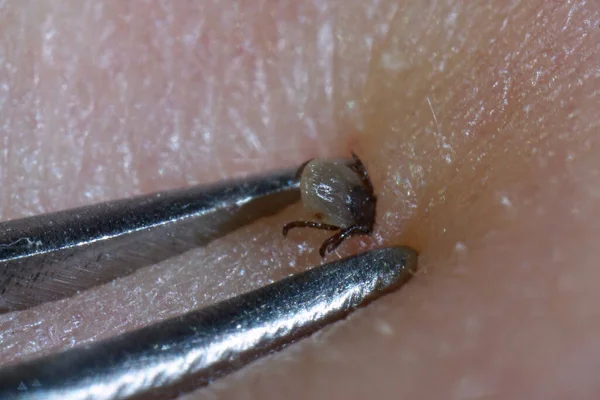 Super Close Sucking Tick Ixodes Ricinus Removal Steel Tweezers Human — Stock Photo, Image