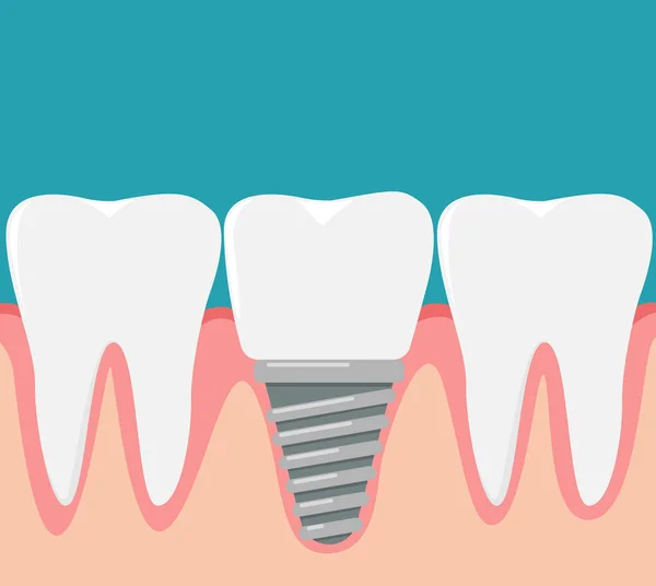 Dientes Humanos Implantes Dentales — Vector de stock