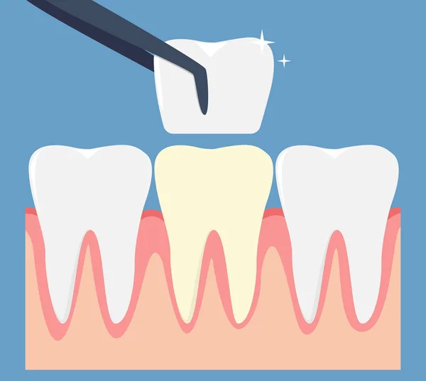 Impiallacciatura Dentale Sul Dente Umano — Vettoriale Stock
