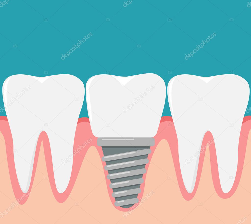 Human teeth and dental implant