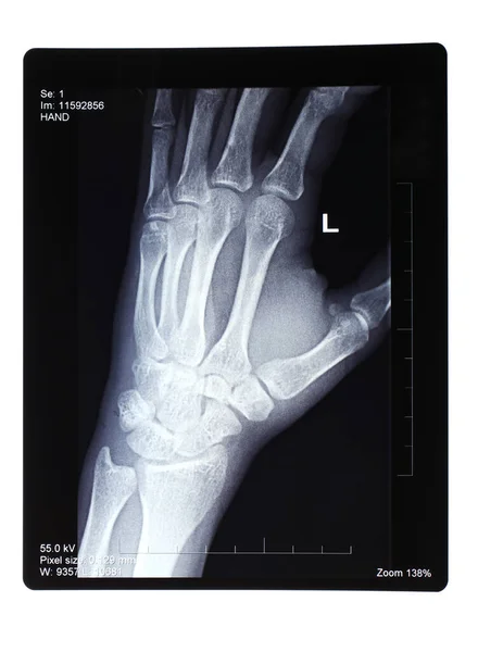 Real Xray Broken Hand — Stock Photo, Image
