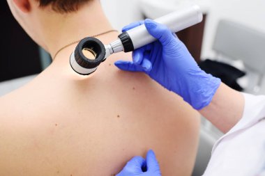 doğum lekeleri ve doğum lekeleri olan bir dermatoscope hastanın doktor dermatolog inceliyor