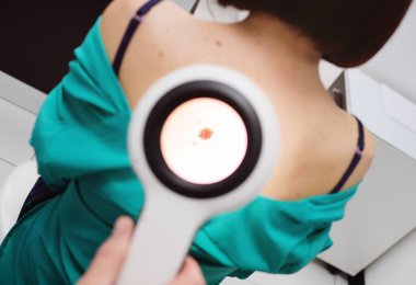 Doktor hastanın bir büyüteç ile doğum lekeleri inceliyor