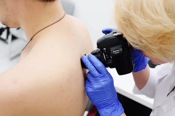 Le médecin dermatologue examine les taches de naissance et les taches de naissance du patient avec un dermatoscope — Photo