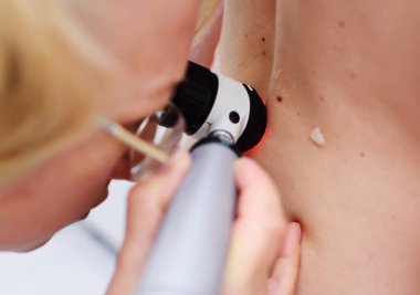 Dermatolog mol veya akne olan bir dermatoscope hastanın inceliyor