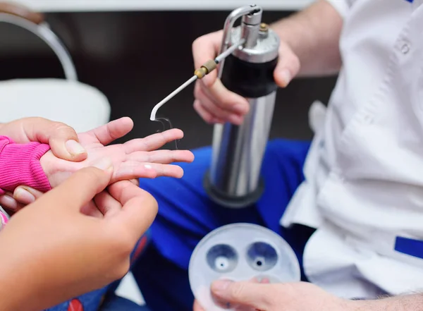 The doctor removes skin formations with special equipment - kriodestruktor. Papillomas, warts, oncology — Stock Photo, Image