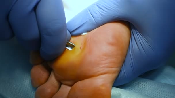 Удаление мозолей или мозолей на ноге хирургически крупным планом — стоковое видео