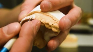 Diş hekimi alçı döküm yapılmış bir implant diş protez yapar. Ortopedik diş hekimliği, protez.