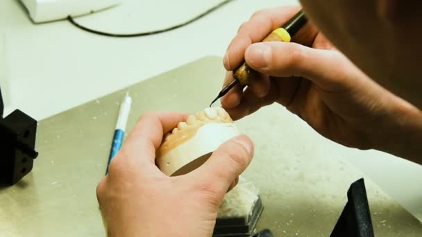 Стоматолог делает зубной имплантат — стоковое видео