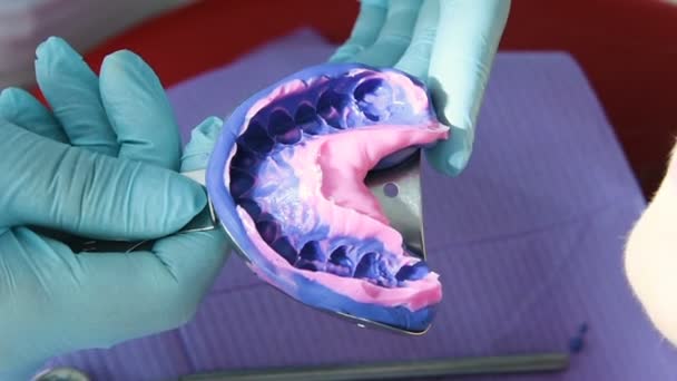 Tandläkaren gör en avgjutning av tänderna för protetik — Stockvideo
