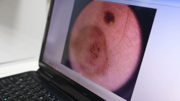 Bir laptop monitör bir Doğum lekesi veya siğiller yakın çekim görüntüsü. — Stok video