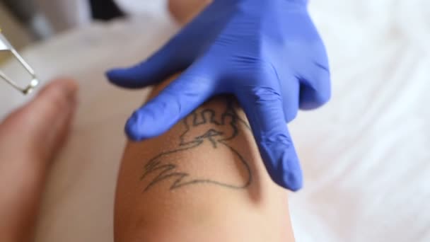 젊은 예쁜 여자의 다리에 문신을 레이저로 제거 하는 미용사. — 비디오