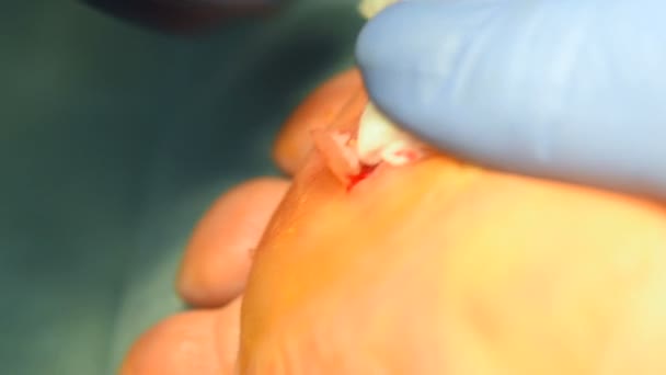 odstranění mozoly nebo kuří oka na noze chirurgicky detail