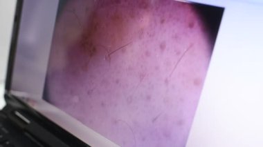 Bir laptop monitör bir Doğum lekesi veya siğiller yakın çekim görüntüsü.