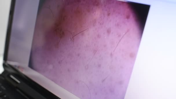 Image of a birthmark or warts close-up on a laptop monitor. — Stock Video