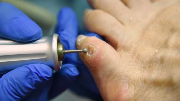 Иссечение мозолей на пальце ноги педикюром — стоковое видео