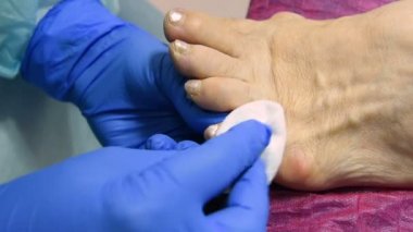 Pedikür makine ile ayak üzerinde nasır eksizyon