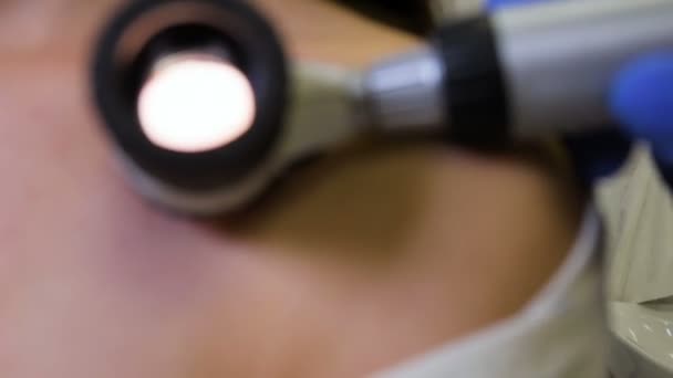 Controles de diagnóstico de melanoma. el médico examina el lunar de los pacientes — Vídeo de stock