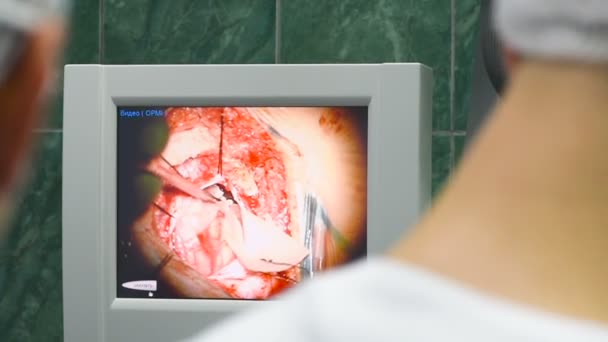 Neurocirurgiões observam cirurgia cerebral em um monitor — Vídeo de Stock