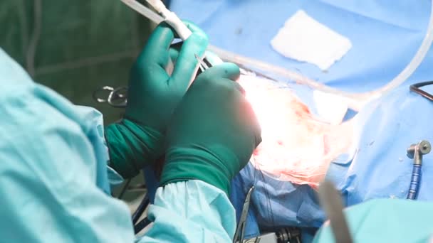 Neurocirurgiões realizam cirurgia para excisar um tumor cerebral — Vídeo de Stock