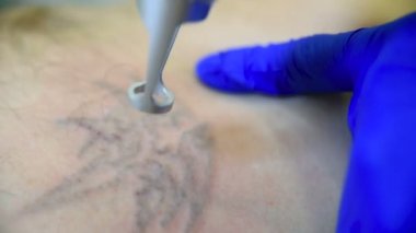 Dövme hasta adam profesyonel lazer güzellik uzmanı Doktor kaldırır.
