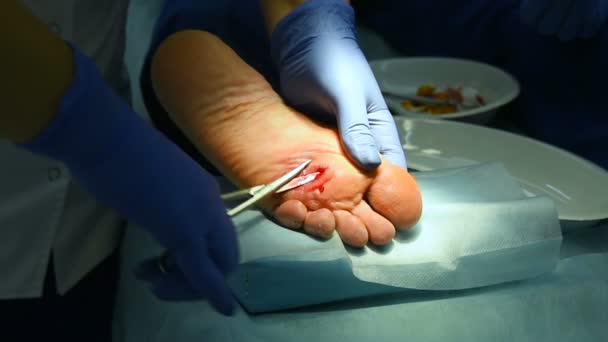 Fjernelse af hård hud eller korn på benet kirurgisk close-up – Stock-video