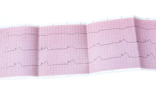 EKG-a heveny időszak macrofocal miokardiális infarktus, Av-blokk Ii fokú típus Mobitts én — Stock Fotó