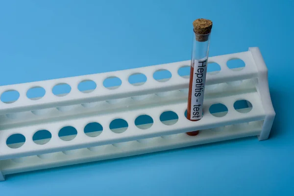 Hepatitis test, bloed in de reageerbuis. — Stockfoto