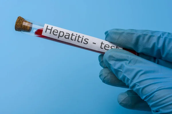 Teste de hepatite, sangue no tubo de teste . — Fotografia de Stock