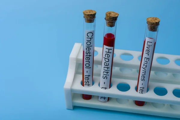 Kolesterol test hepatit test och lever enzym test, in vitro. — Stockfoto
