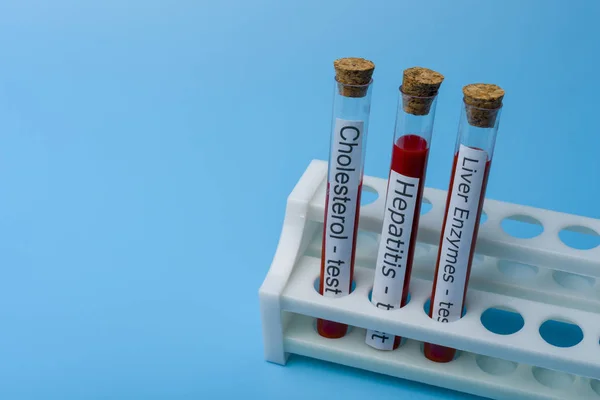 Teste de colesterol Teste de Hepatite e Enzima hepática, in Vitro . — Fotografia de Stock