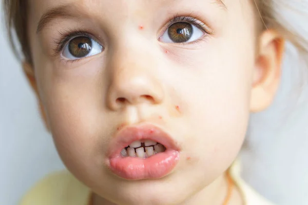 The face of a little girl with skin rashes is a close-up view. Treatment of rashes, acne, pimples dermatic diseases, contagious mollusks on skin in children. Copy space.