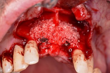 Yetişkinlerin üst diş implantlarının düşük açılı görüntüsüne sahip yatay renk görüntüsü (Diş numarası 11 ve 21))