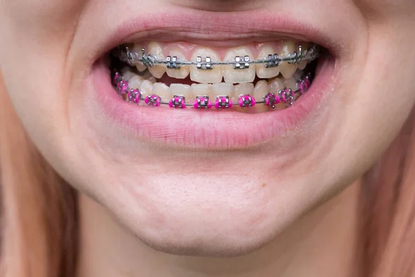 Hermosa Joven Con Abrazaderas Dentales Metal Con Dientes Blancos —  Fotos de Stock