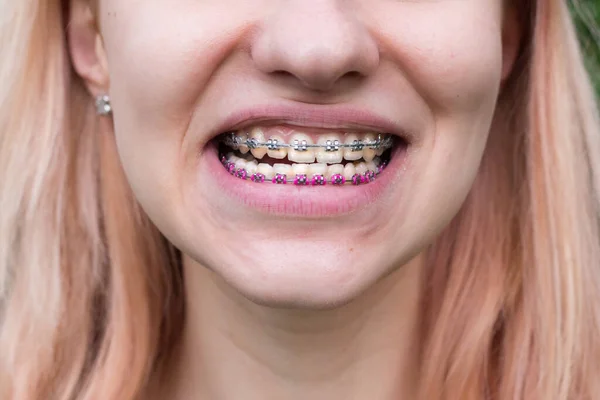 美しいです若いです女の子とともに金属歯のブレースとともに白い歯 — ストック写真