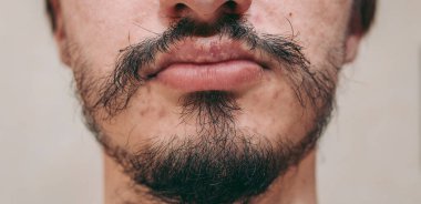 Bir adamın yüzünde yamalı sakal