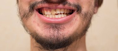 Yamuk sakallı bir adamın eğri dişleri.