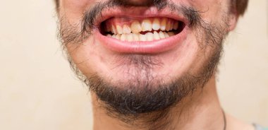 Yamuk sakallı bir adamın eğri dişleri.