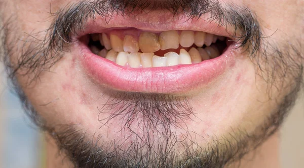 Crooked Teeth Man Patchy Beard — Stock Photo, Image