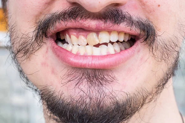 Криві Зуби Чоловіка Пишною Бородою — стокове фото