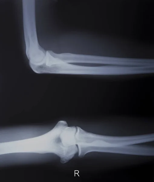 右臂X光显示右肘骨折 图库图片